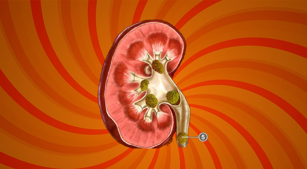 prazeres-do-calculo-renal